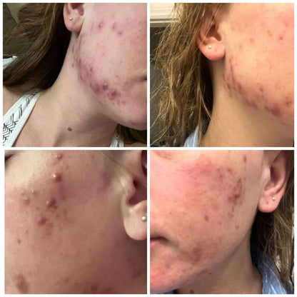 The Spoiled Mama BalanC Toner - Bright Clear Skin Pregnancy-Safe Acne Toner