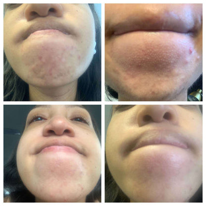 The Spoiled Mama BalanC Toner - Bright Clear Skin Pregnancy-Safe Acne Toner