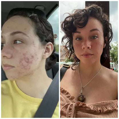 BalanC Acne Toner: Pregnancy Safe Skincare